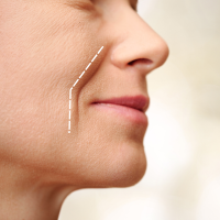 Nasolabial folds & Marionette lines