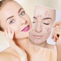 Acne & Skin Repair